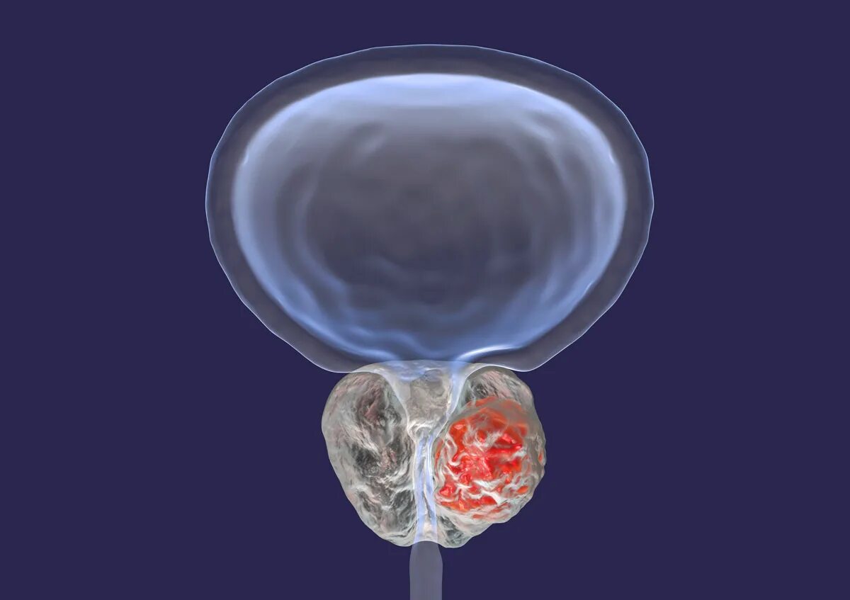 Химия простаты. Простатит фон.