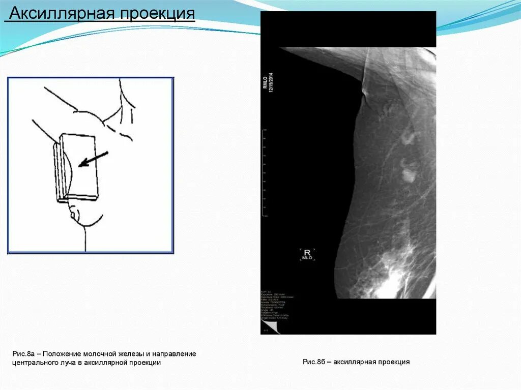 Аксиллярная проекция. Аксиллярная проекция маммография. Аксиллярная зона молочной железы что это. Укладка маммография аксиллярная проекция. Аксиллярная лимфаденопатия молочной