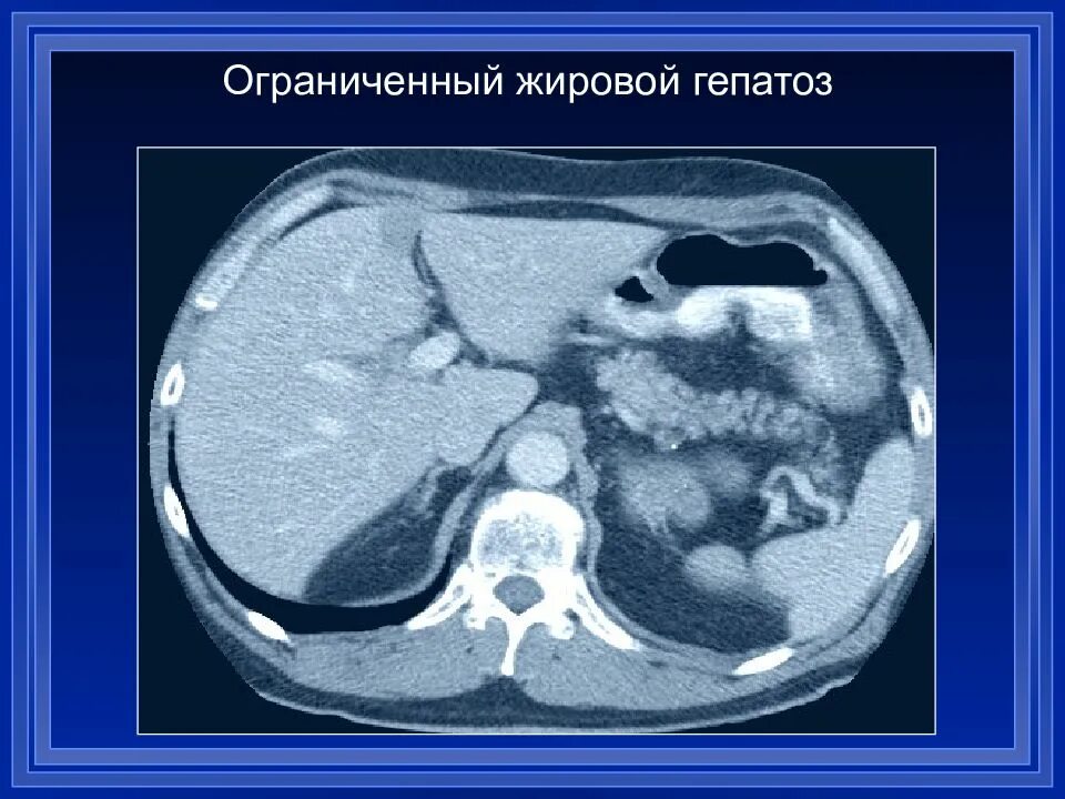 Фокальный жировой гепатоз печени кт. Очаговый гепатоз печени кт. Очаговый жировой гепатоз печени кт. Жировой гепатоз печени на кт. Лечение жирового гепатоза поджелудочной