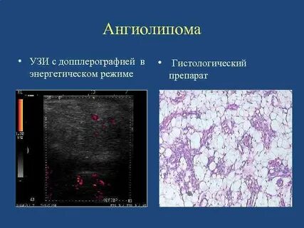 Ангиолипома почки что это