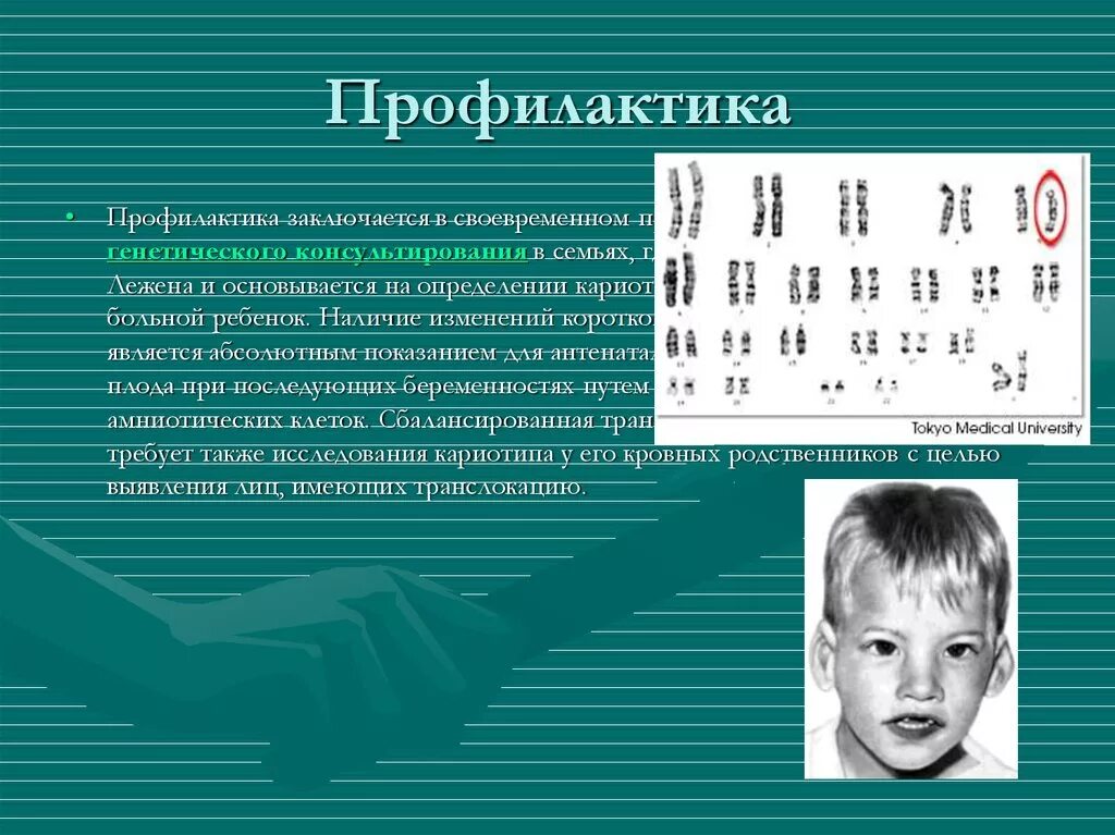 Синдром кошачьего крика симптомы. Идиограмма синдрома кошачьего крика. кариотип больного с синдромом кошачьего крика. кариотип свойственный синдрому кошачьего крика. кариотип девочки с синдромом кошачьего крика.