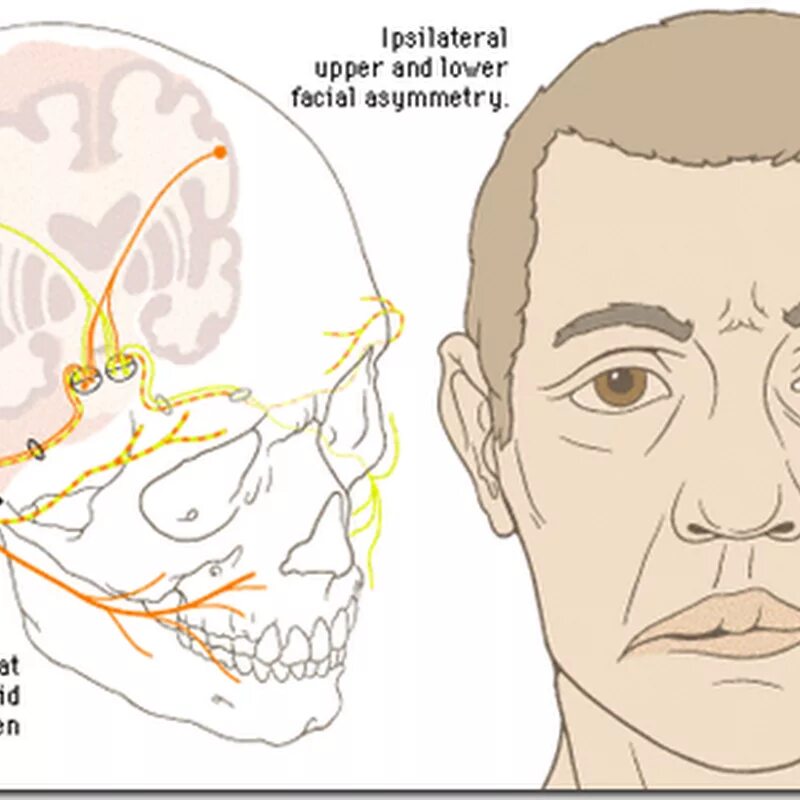 Повреждение нервов лица. Паралич лицевого нерва неврология. асимметрия лица при чмт. асимметрия лицевого нерва.