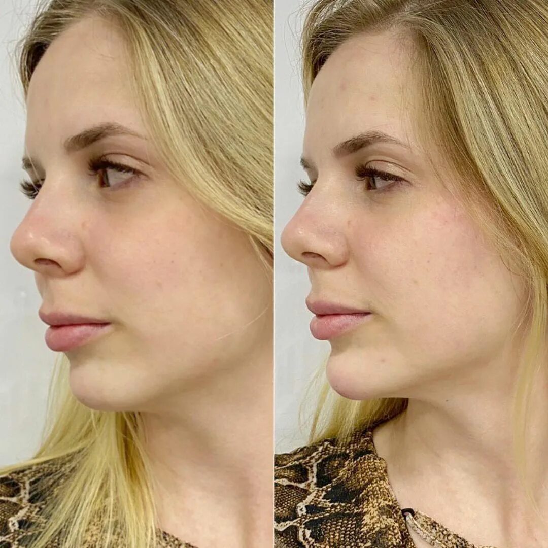 контурная пластика подбородка филлерами. гурьянов ментопластика. контурная пластика подбородка филлерами. ментопластика пластика подбородка. коррекция подбородка филлерами.