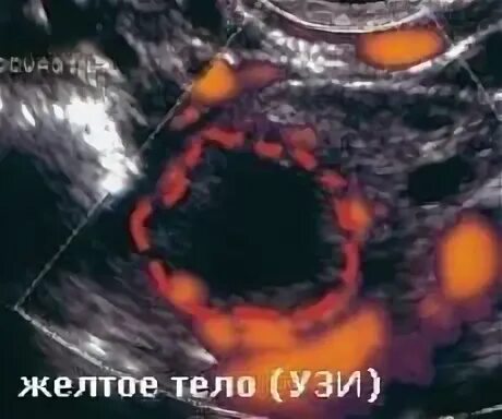 Забеременеть при желтом теле