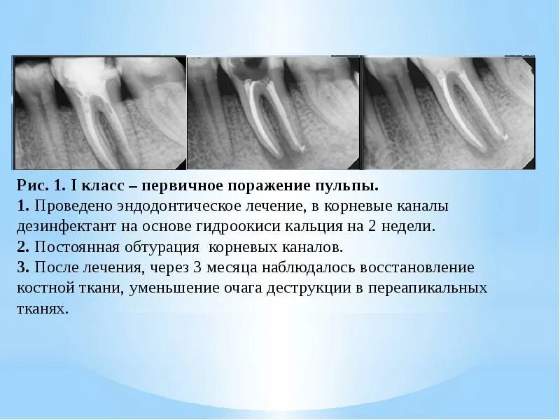 Пломбирование корневых каналов кальцием. Кальций для корневых каналов.