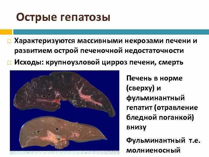 Острая жировая печень. Гепатоз печени патоморфология. Массивный прогрессирующий некроз печени макропрепарат. Массивный прогрессирующий некроз печени патанатомия. Токсический гепатоз печени.