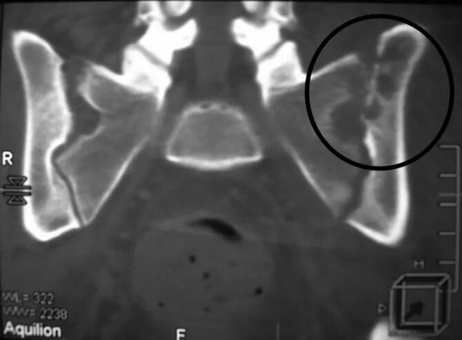 Кт подвздошной кости. Остеомиелит тазобедренного сустава мрт. Остеомиелит крестца мрт. Остеомиелит костей таза.