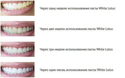 Как отбелить зубы без вреда