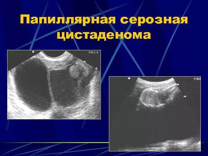 Серозная цистаденома яичников. Папиллярная серозная цистаденома яичника. Сосочковая цистаденома яичника на УЗИ.