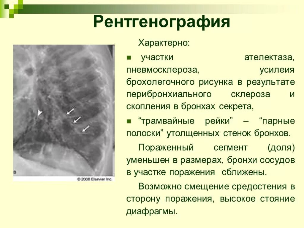 Причины изменений в легких. Пневмосклероз рентген признаки. Рентген признаки пневмофиброза. Пневмосклероз легких рентген признаки. Бронхоэктатическая болезнь рентген.