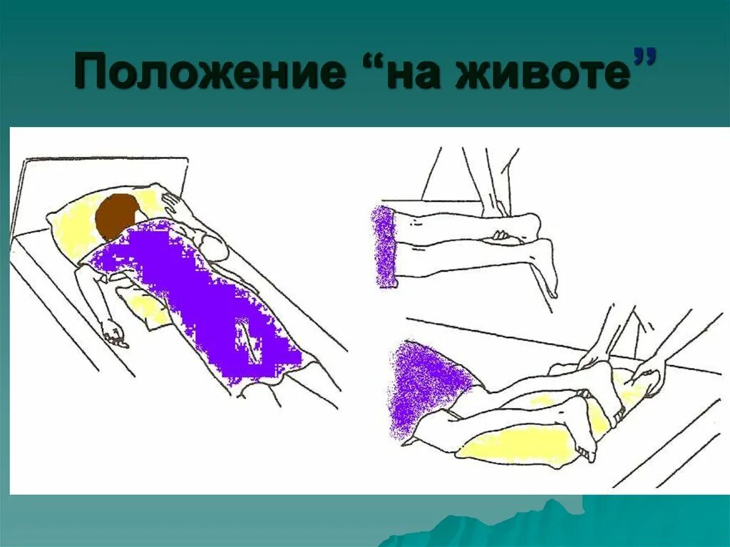 Операция лежа на животе. Положение пациента на животе. Размещение пациента на животе. Положение лежа на животе. Укладывание пациента на живот.