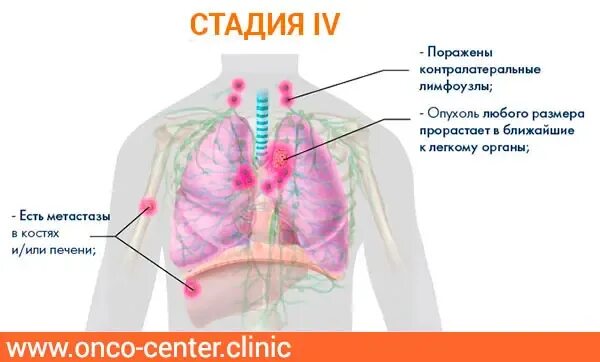 В лимфоузлах метастазы выживаемости