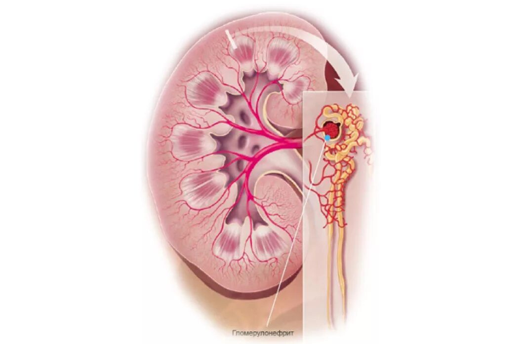 нарушение почечных канальцев. поражение клубочков гломерулонефрит. нарушение канальцевой реабсорбции в почках. патогенез нарушения канальцевой реабсорбции. почечные симптомы гломерулонефрита.