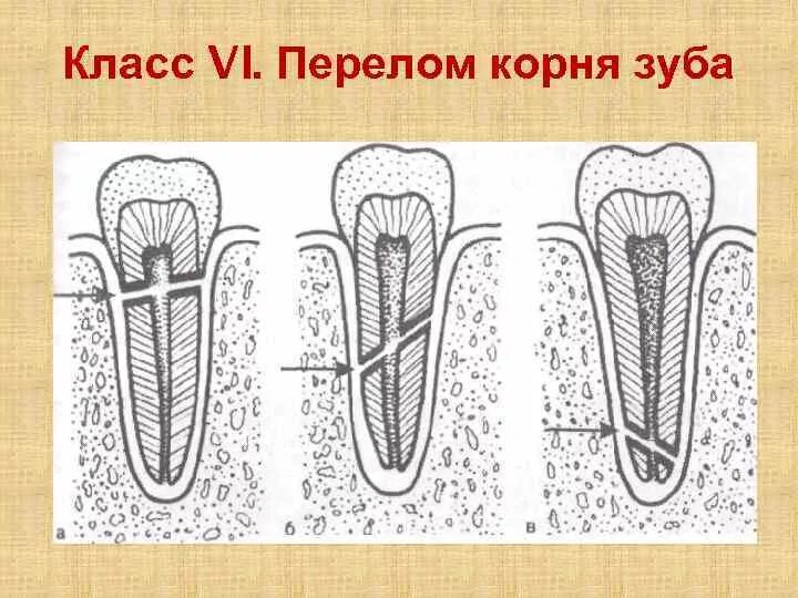 Коронково корневой перелом. Переломы зубов классификация. Перелом корня зуба классификация.