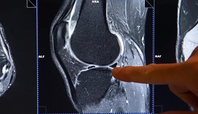 Пателлофеморальный артроз мрт. Артроз коленного сустава мрт снимок. Остеоартроз коленного сустава мрт. Гонартроз 1 степени мрт.