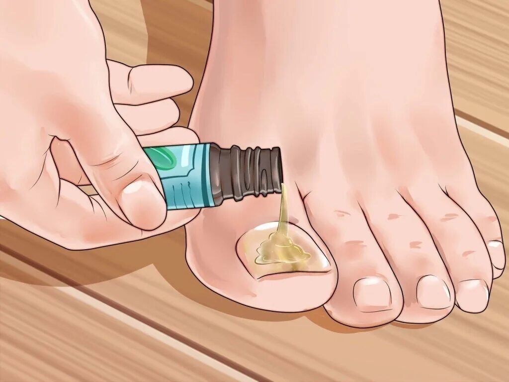 Лечение грибка маслом. Онихомикоз ( обработка грибковых ногтей). Обработка грибковых ногтей на ногах.