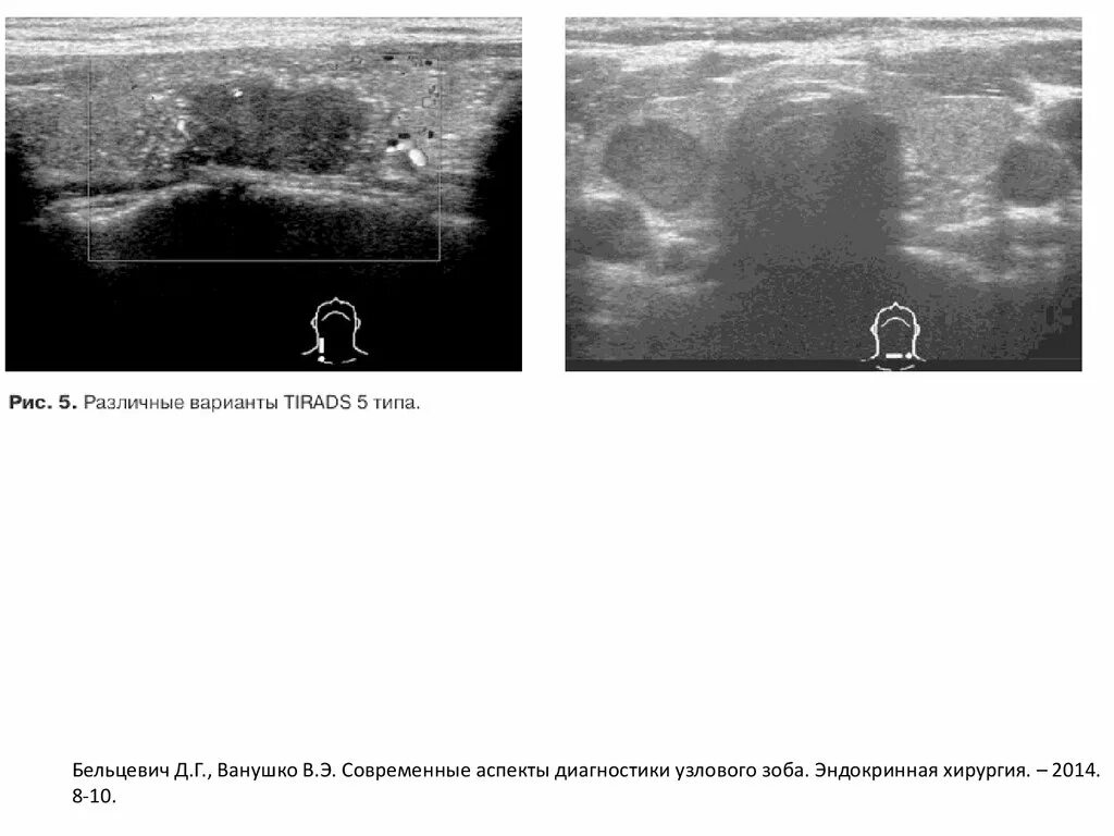 Классификация Tirads щитовидная железа УЗИ. УЗИ щитовидной железы зоб. Tirads классификация узлов щитовидной железы ультразвуковая. Диффузно узловое образование