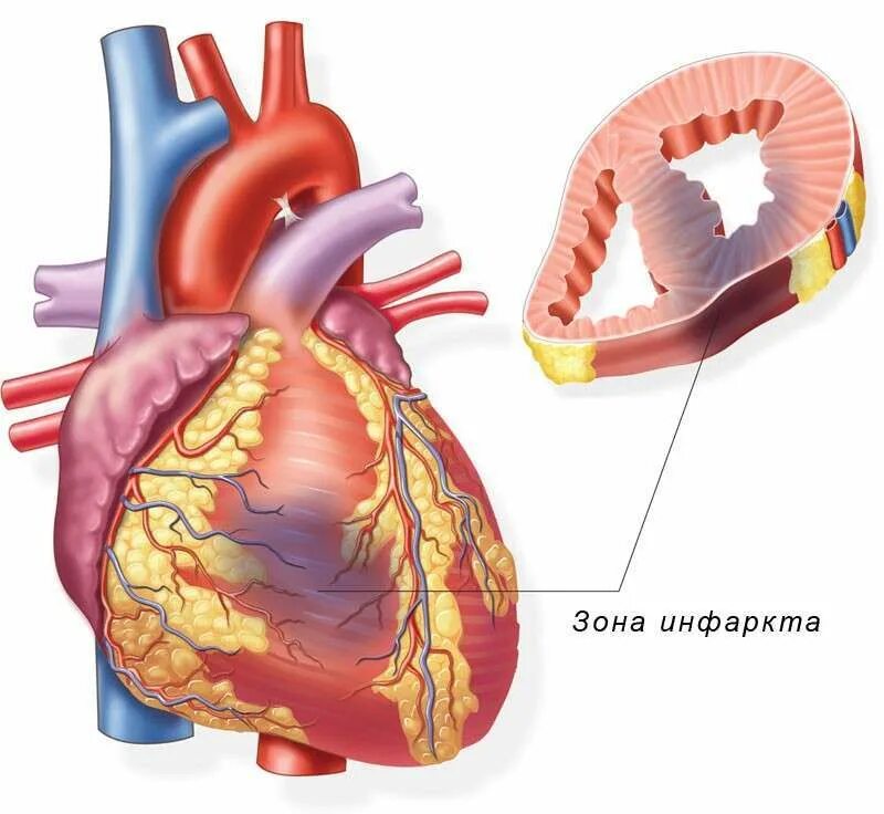 Ишемия у мужчин. Инфаркт миокарда сердце. Форма очага некроза при остром инфаркте миокарда. Патологии сердца инфаркт миокарда. Инфаркт миокарда поражение.