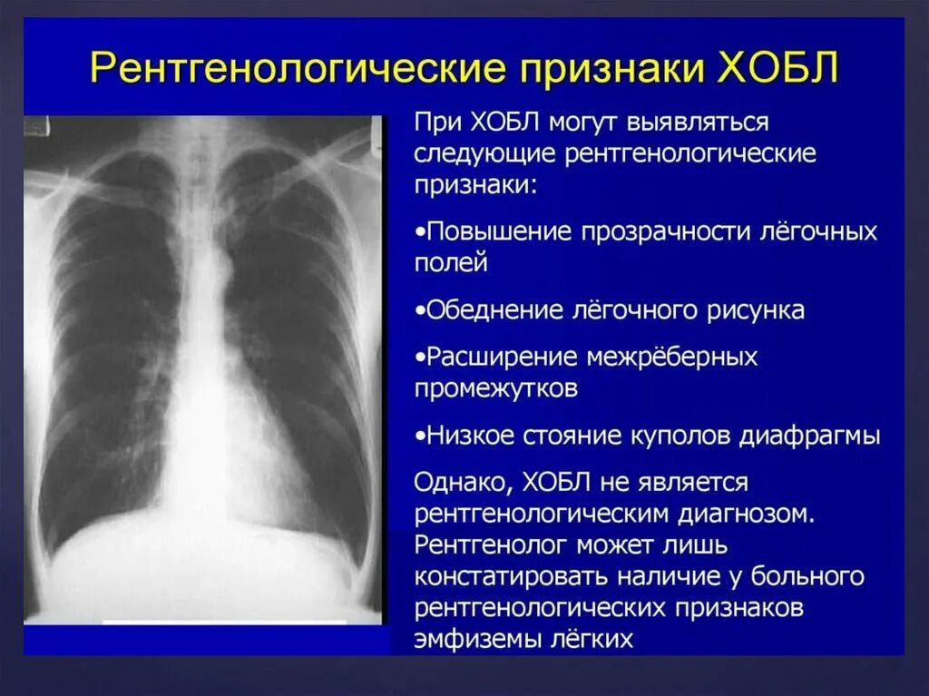 Рентгенологические признаки эмфиземы легких. Заключение рентген при ХОБЛ эмфиземе. ХОБЛ рентгенологические признаки. ХОБЛ описание рентгенограммы.