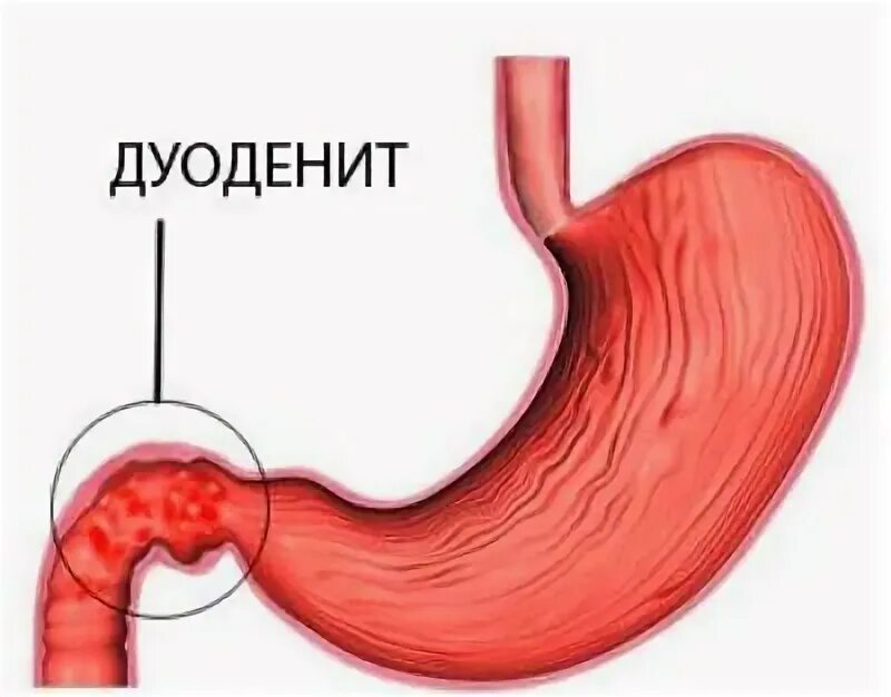 Симптомы хронического дуоденита