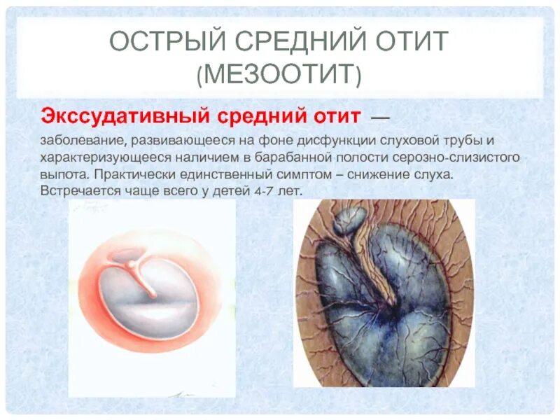 Психосоматика уши отит. Психосоматика уши отит