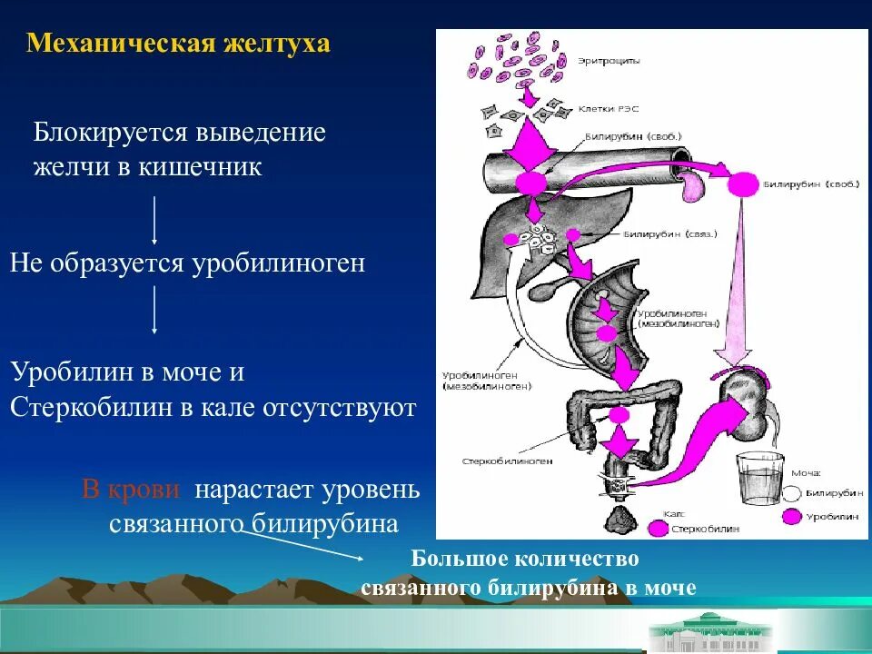 Постпеченочная желтуха патогенез. Обтурационная (механическая) желтуха патогенез. . Подпечёночная желтуха механизм развития. Обтурационная желтуха механизм развития.