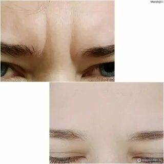 Ботокс лба нависшее веко