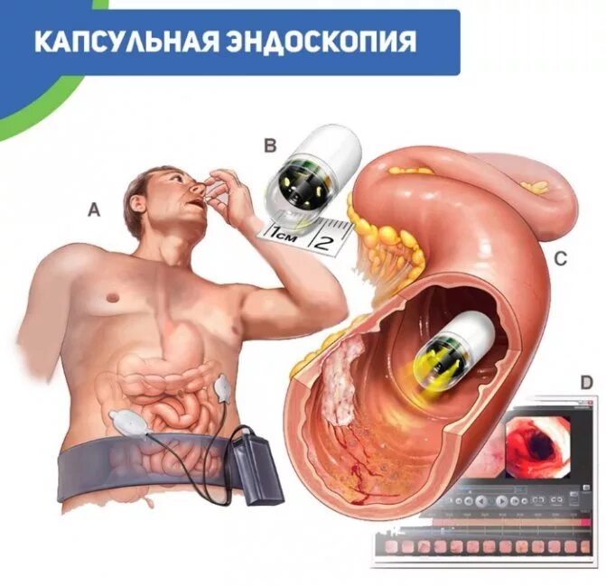 Как обследовать кишечник