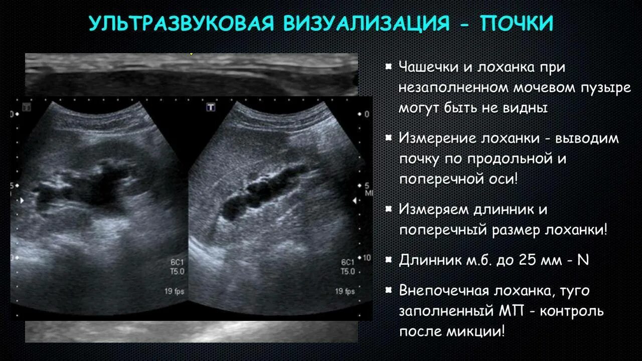 Расширение лоханки у ребенка. Измерение почечной лоханки на УЗИ. Расширение ЧЛС почек на УЗИ. Расширение лоханки почки на УЗИ. Нормальная почка паренхима на УЗИ.