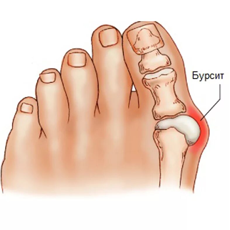Бурсит вальгусной косточки. Бурсит 1-го плюснефалангового сустава. Бурсит косточки большого пальца стопы. Бурсит большого стопы
