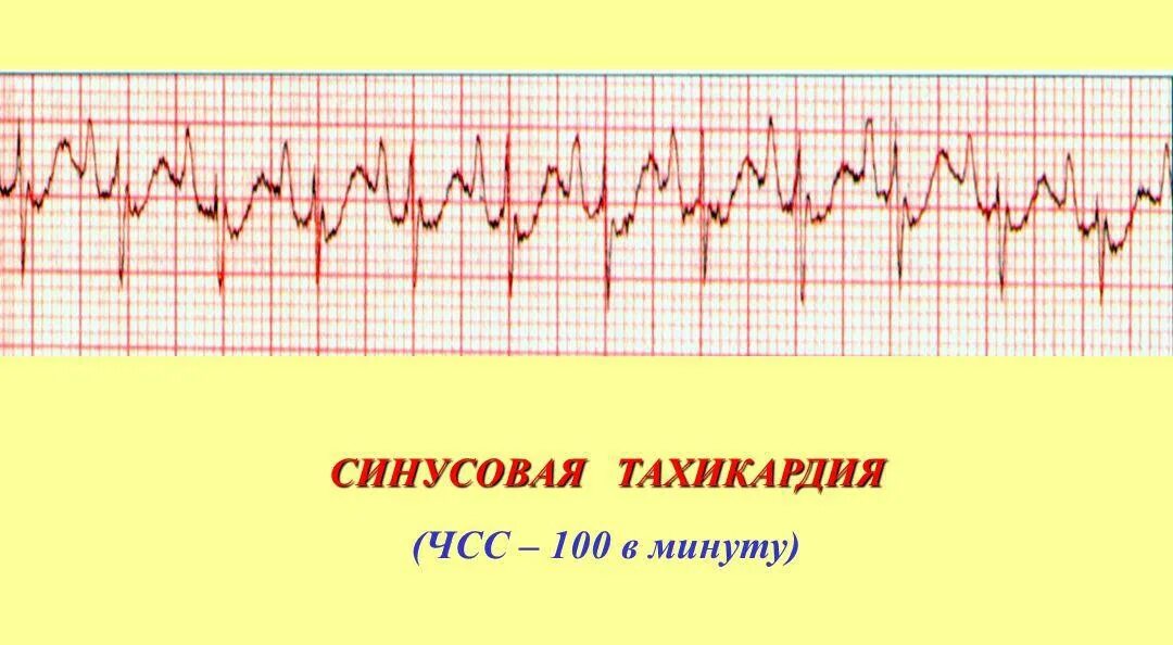 Тахикардия сколько ударов в минуту. Синусовая тахикардия с чсс 100. синусовая тахикардия чсс 100 в минуту. при синусовой тахикардии. чсс при синусовой тахикардии.