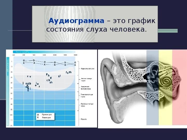 Аудиограмма норма. Тональная пороговая аудиограмма норма. Аудиограмма слуха. Аудиограмма нормального слуха. Речевая аудиометрия график.