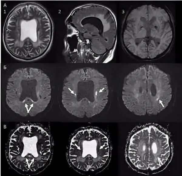 Очаги дисциркуляторного дистрофического характера. Мрт картины очагово. МР картина единичных очаговых изменений вещества мозга. Очаговое изменение белого вещества дистрофического характера. Очаговые изменения дисциркуляторного дистрофического характера