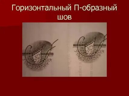 П образный шов