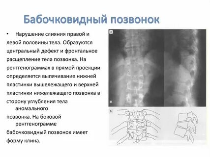 У ребенка клиновидный позвонок