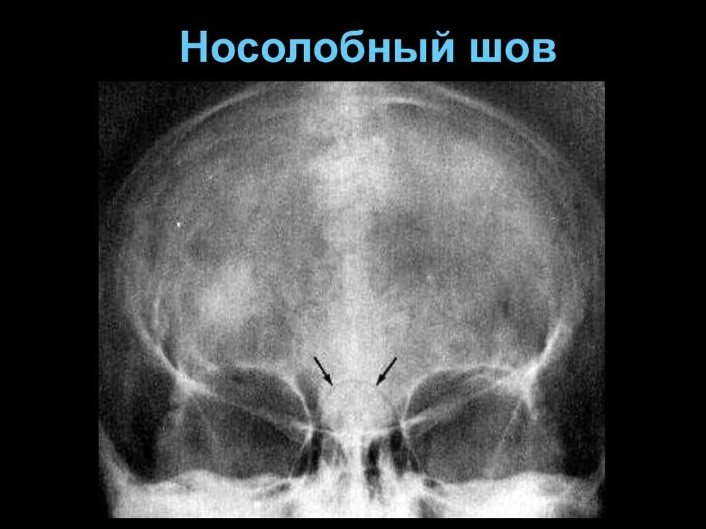 Носовой шов. Рентгеноанатомия костей черепа. скуловерхнечелюстной шов кт. носолобный шов. рентгеноанатомия черепа и головного мозга.