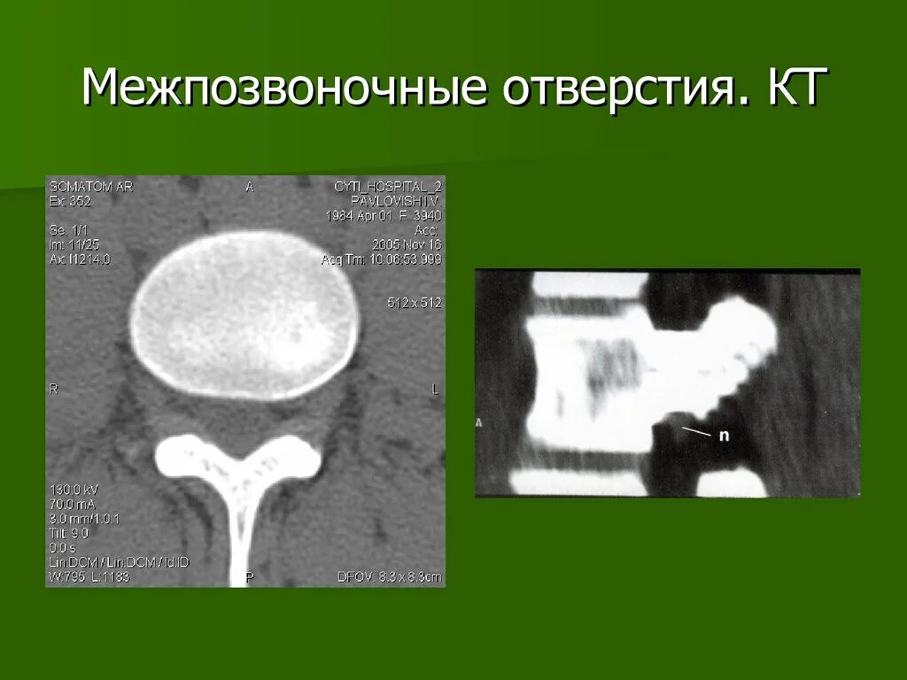Межпозвоночное отверстие образуется. Межпозвоночное отверстие. межпозвонковые отверстия. межпозвонковые отверстия на кт. межпозвоночное отверстие кт.