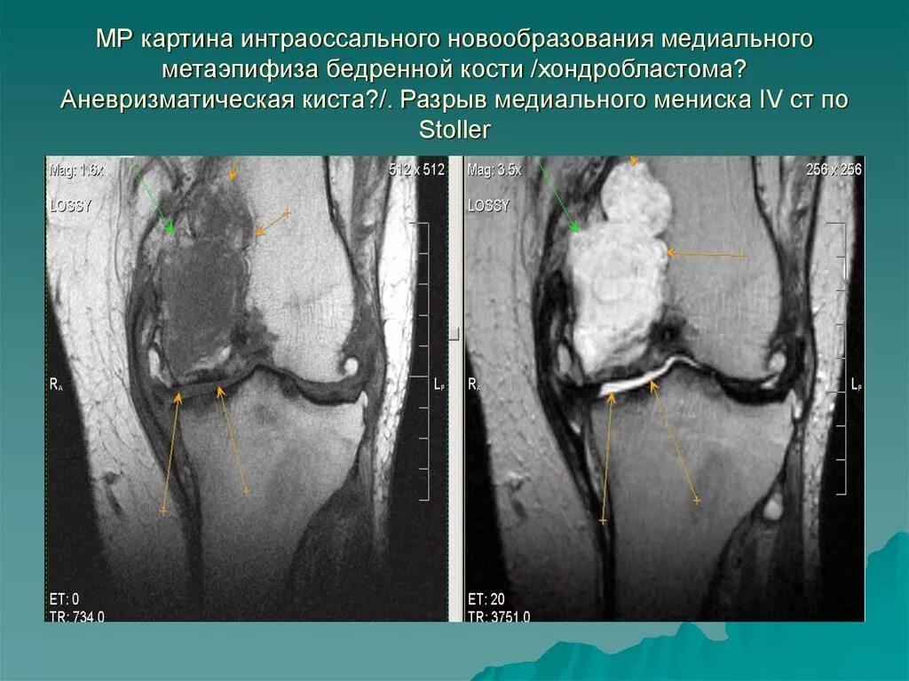 Мр картина дегенеративных изменений медиального мениска