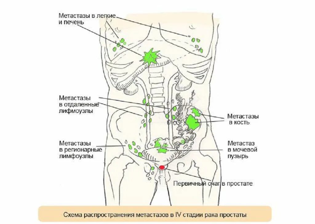 Метастазы в кости при раке предстательной. Регионарные лимфатические узлы мочевого пузыря. Лимфатические узлы малого таза схема. Регионарные лимфатические узлы простаты. Регионарные лимфоузлы предстательной железы.