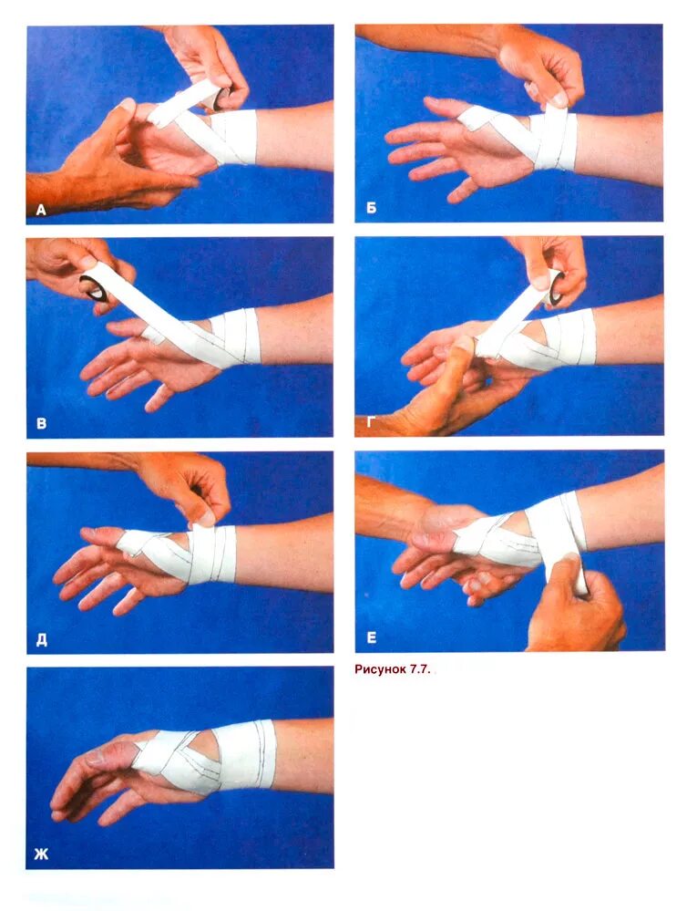 Перевязка большого пальца. Повязка при ушибе пальца на руке. Перебинтованный большой палец на руке. Как перевязать кисть