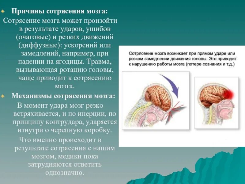 Сотрясение при ударе. Синдромы при сотрясении мозга. Механизм сотрясения головного мозга.