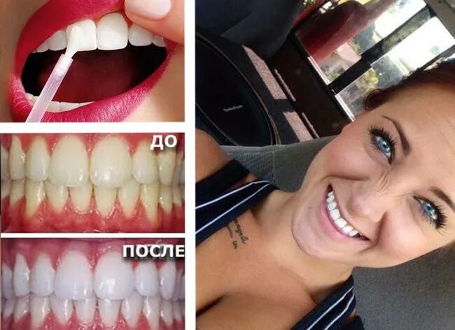 Аппаратное отбеливание. Баннер день гигиениста. Зубы до и после отбеливания. Отбеливание вологда. Зубы до и после лазерного отбеливания.