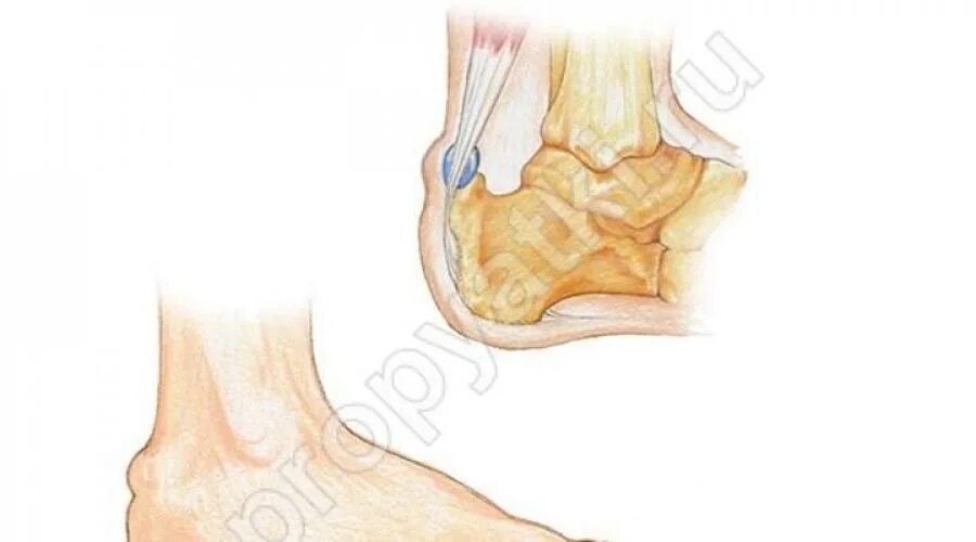 Болят пятки ног после ходьбы. Ахиллобурсит сухожилия. Болезнь Хаглунда-Шинца. Ахиллобурсит пяточной кости.