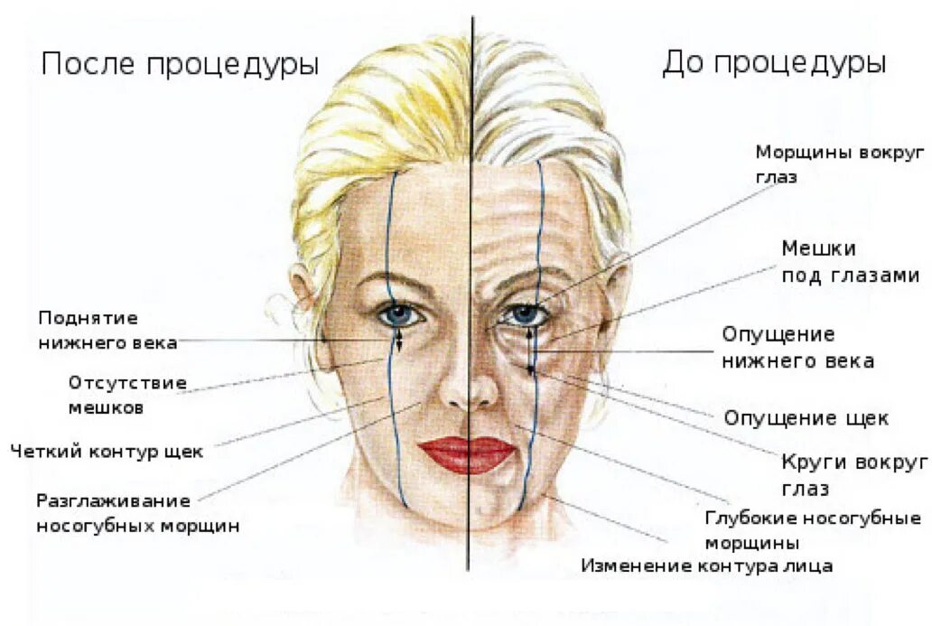 Со скольки лет делают ботокс. Мышцы лица анатомия для косметологов для ботокса. схемы куда колоть ботулакс. схема лица мышцы ботокс. куда можно колоть ботокс на лице схема.