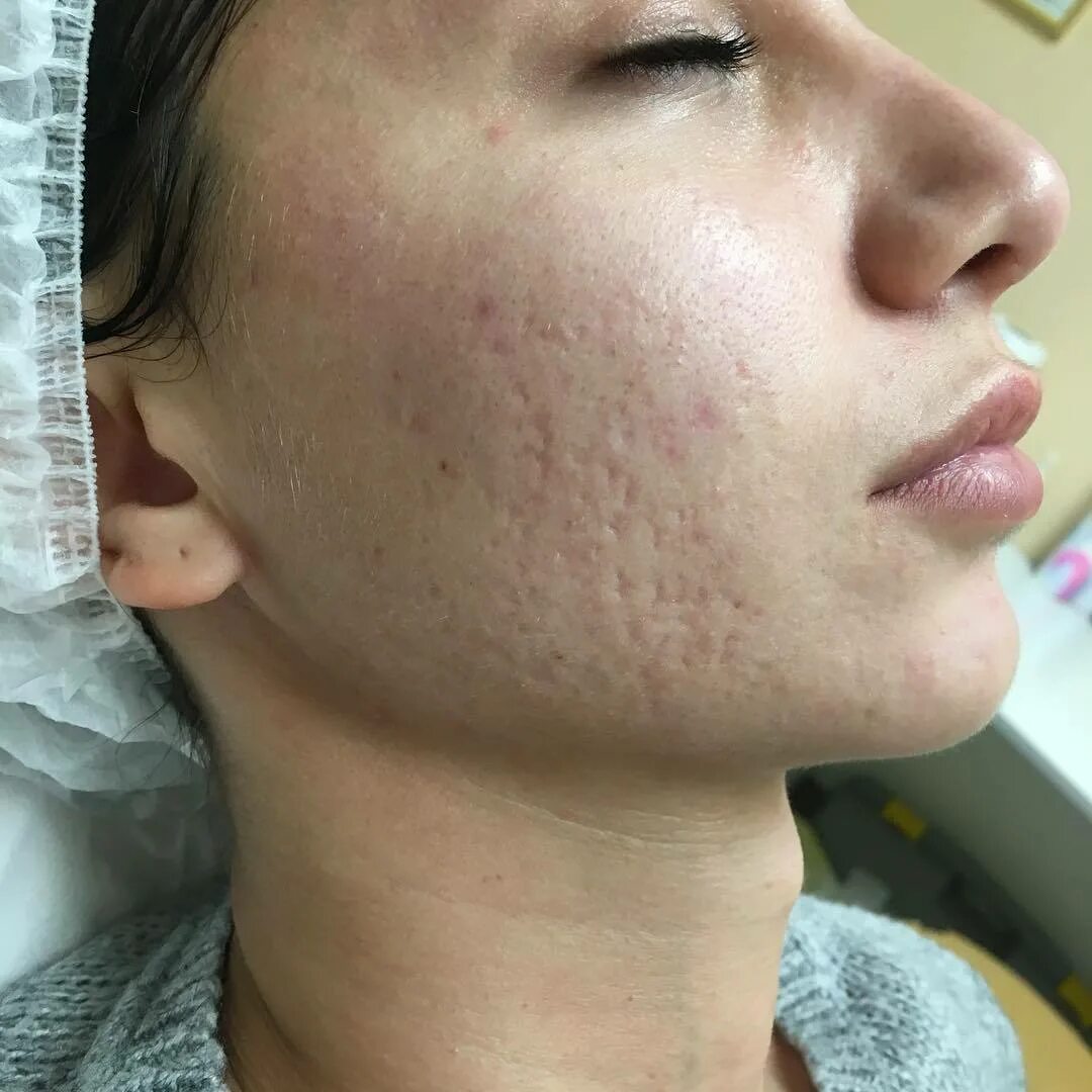 фракционный лазерный термолиз. холодный пилинг лица. лазерная дермабразия розацеа. пигментация на лице до и после. лазерный пилинг фраксель fraxel лицо.