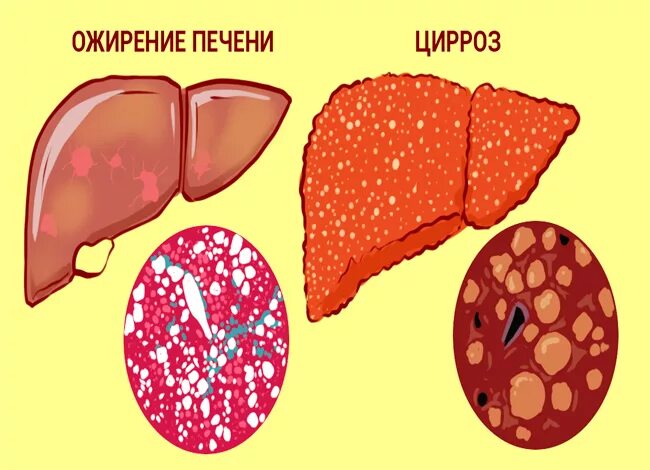 Печень после еды. Холестерин при циррозе.