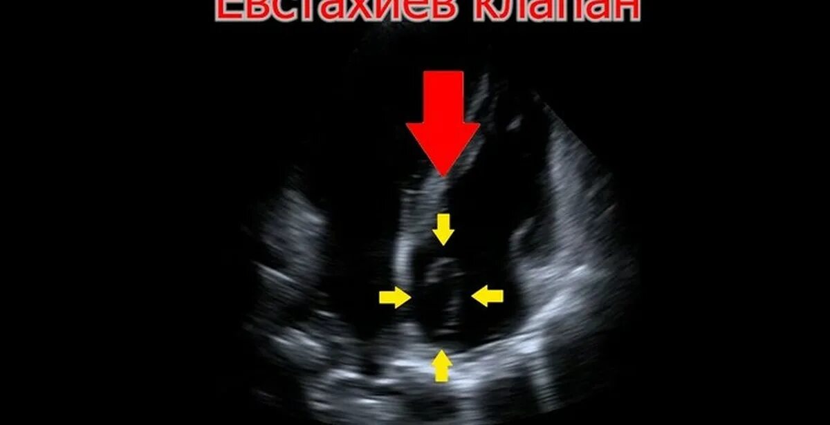 Удлиненный клапан. Удлиненный евстахиев клапан УЗИ сердца. Клапан нижней полой вены (евстахиев клапан). Евстахиев клапан на ЭХОКГ. Удлинённый евстахиев клапан.
