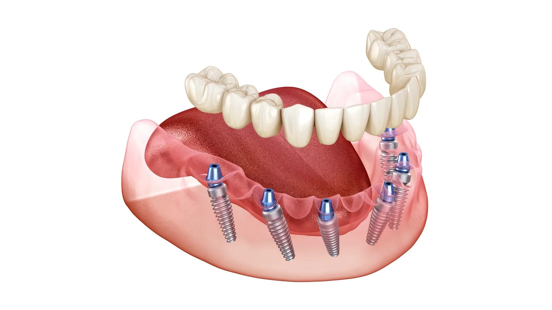 Несъемный протез на 4 имплантах. Внутрислизистые зубные имплантаты. Протезирование зубов инвалидам 3 группы