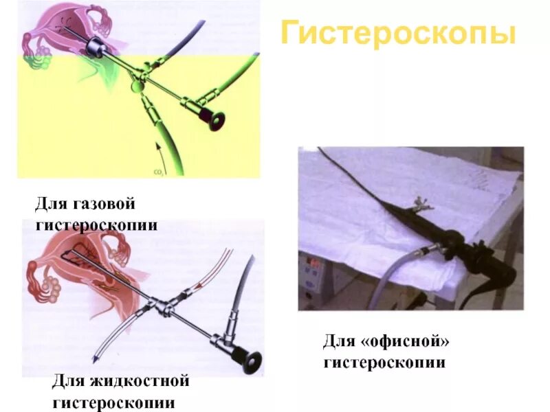 После офисной гистероскопии. Кольпоскопия что это такое в гинекологии. Гистероскопия мочевого пузыря. После офисной гистероскопии. Гистерорезектоскопия миомы матки.