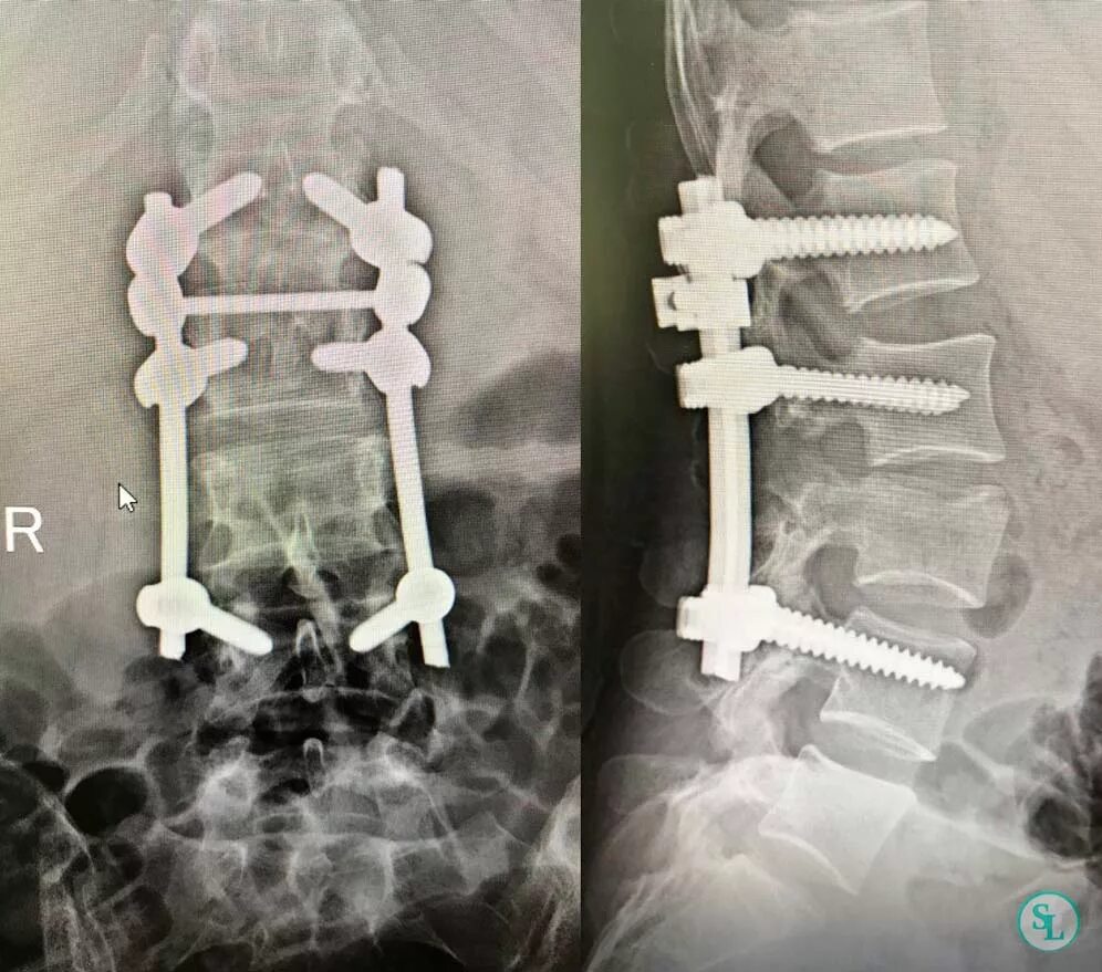 Транспедикулярный остеосинтез позвоночника. Транспедикулярная фиксация l1-l2-l3-l4-l5 системой. Компрессионный перелом позвонков l3 l4. Межтеловой Кейдж рентген. Компрессионная операция на позвоночнике